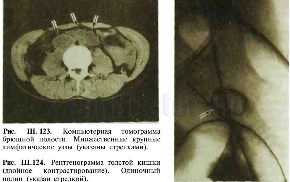 рентгенограмма толстой кишки и КТ брюшной полости